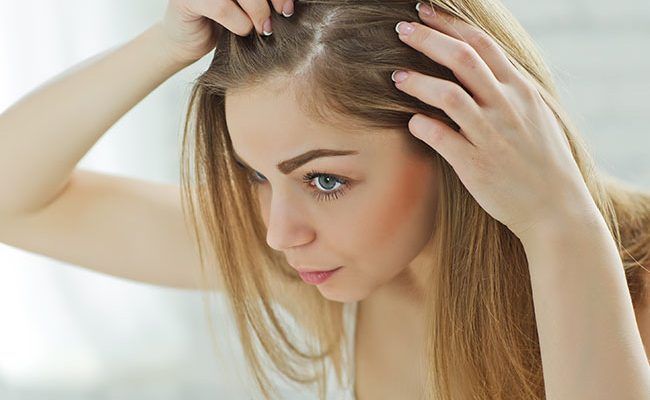 Hair loss women