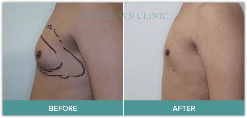 gynaecomastia surgery in sydney