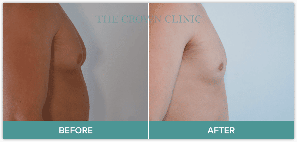 male breast reduction treatment in sydney