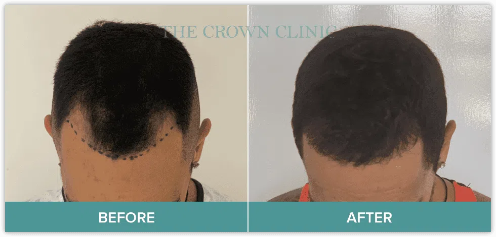 Hvem Athletic Uganda FUE Hair Transplantation Sydney| The Crown Clinic