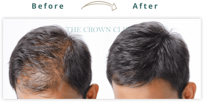 hair restoration surgery